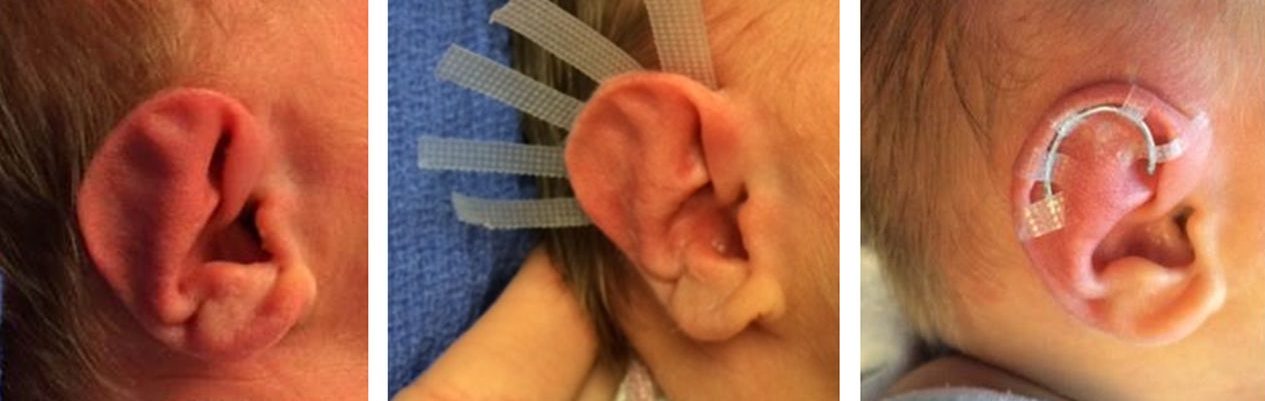 Elf Ear Surgery