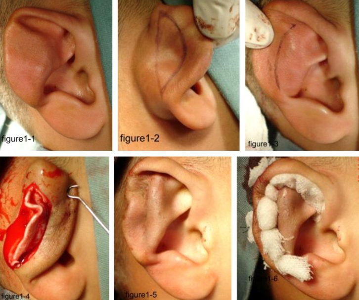 Elf Ear Surgery